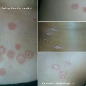 Vanessa's bed bug bites after vacation.