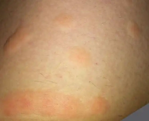 Swollen raised bites from bed bugs.
