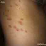 Picture of Vivians bug bites 2 of 2