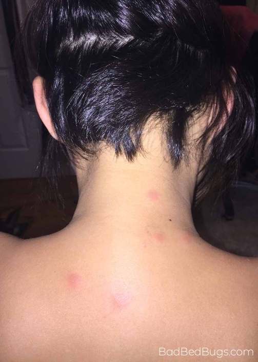 Woman bitten on the back by a bed bug
