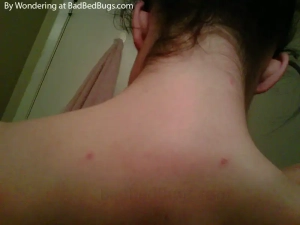Red bedbug bites on neck of this teenager.